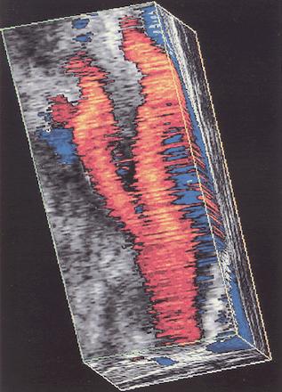 An example of Texture mapping: Three-dimensional color Doppler US image of the carotid artery shows the sharply jagged irregularity of the vessel wall and the color pattern caused by