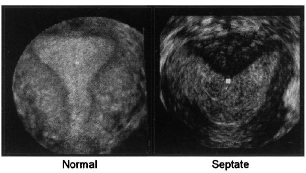 Gynecology: One of the most important applications is characterization of uterine anomalies - Viewing transverse plane