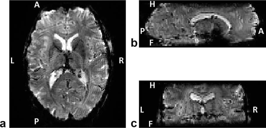348 van der Zwaag et al. FIG. 2. Example slices taken from a human data set with a spatial resolution of 1.5*1.5*2 mm and 32 segments. a: transverse, (b) sagittal, and (c) coronal planes.