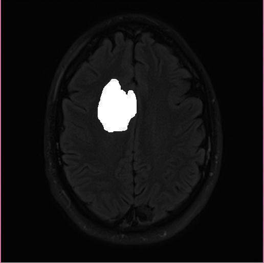Fig.6. Image after Morphological Operation on threshold Operation on Main MRI data 1 0.8 0.6 0.4 0.