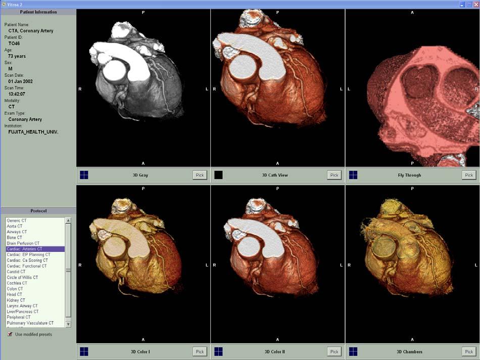 When you select the Cardiac: Arteries CT protocol to automatically sculpt 3D images of the heart to expose the epicardium, you will see a rough segmentation in the preset review windows and the