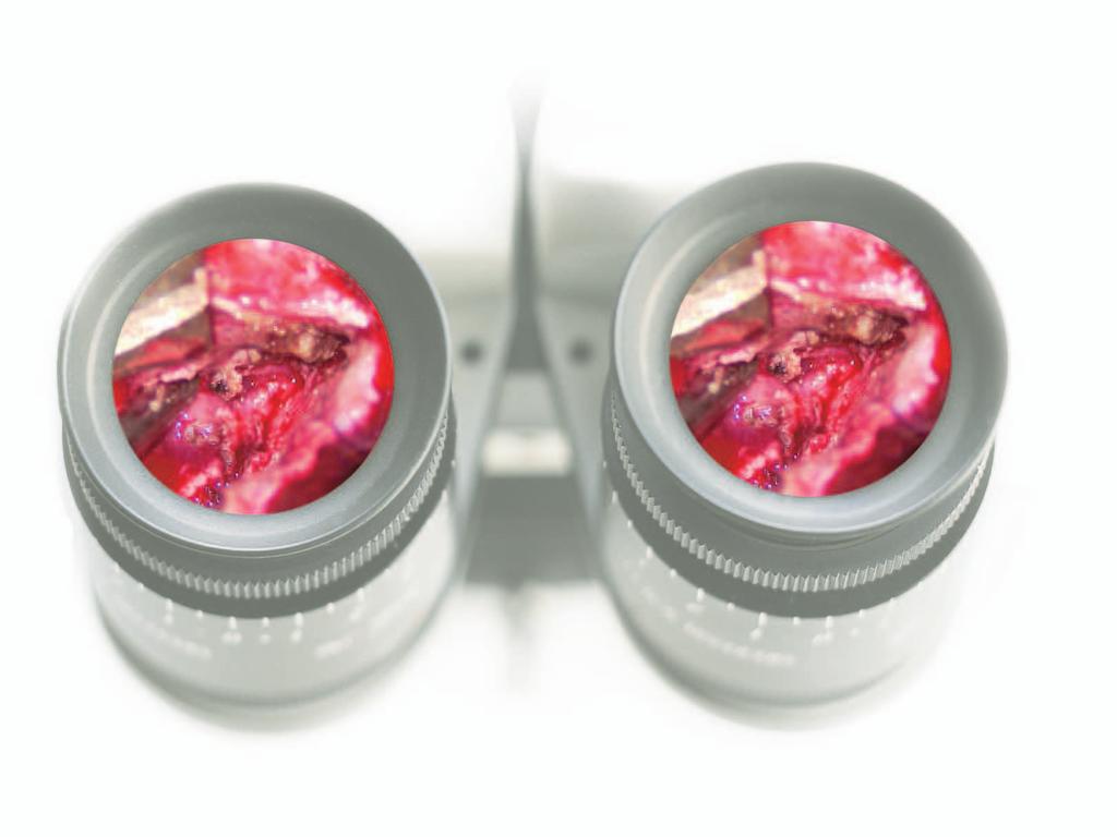 Visualize Blood Flow The Leica FL800 is used in conjunction with the fluorescent agent IndoCyanineGreen (ICG) to view vascular blood flow directly through the surgical microscope eyepieces or on a