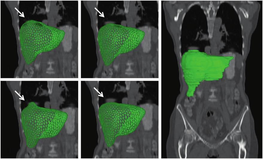 456 S. Zhang et.al. 3 Experiments Liver Segmentation from Low-dose CT: We evaluate the segmentation performance of our system, using 3D low-dose CT data from PET-CT.