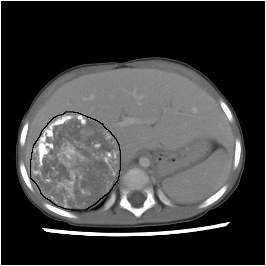 CT Image of Neuroblastoma Abdominal tumors are most common: the worst prognosis.
