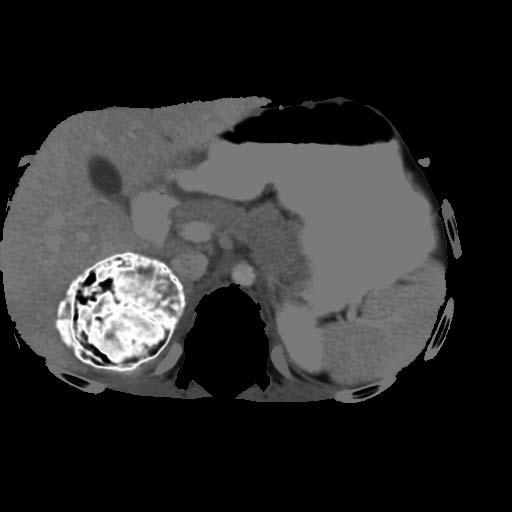 Segmentation of Neuroblastoma: Homogeneous Tumor a b a. tumor segmented by a radiologist c d b.