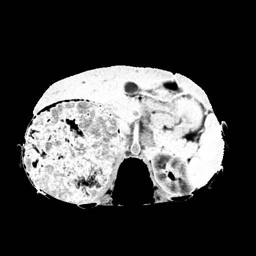 Segmentation of Neuroblastoma: Heterogeneous Tumor a c b d a. tumor segmented by a radiologist b.