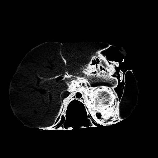 Segmentation of Neuroblastoma: Diffuse Tumor a b a. tumor segmented by a radiologist c d b.