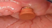 0 Inside the mouth, the Novaloc forming/fixing matrix is placed onto the