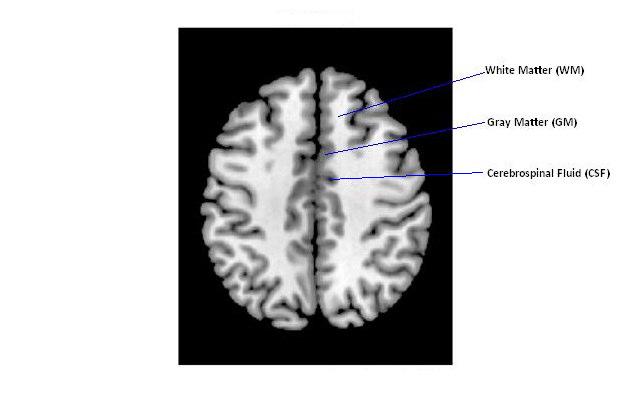 Figure 11. Pre-processed (using approach B) MRI image: Gray matter (GM), white matter (WM) and Cerebrospinal Fluid (CSF).
