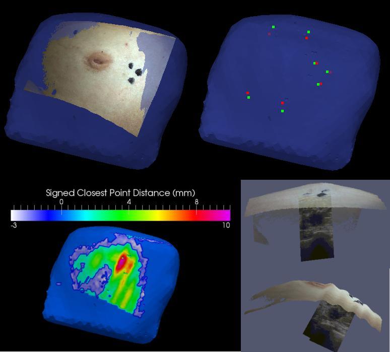 of the probe surface can be used to estimate the displacement of the breast tissue.