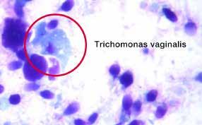 latent trichomoniasis fungal