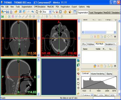 3.2 MIMICS based Module International Journal of Science and Research (IJSR) Mimics interactively read CT/MRI data in the DICOM format.