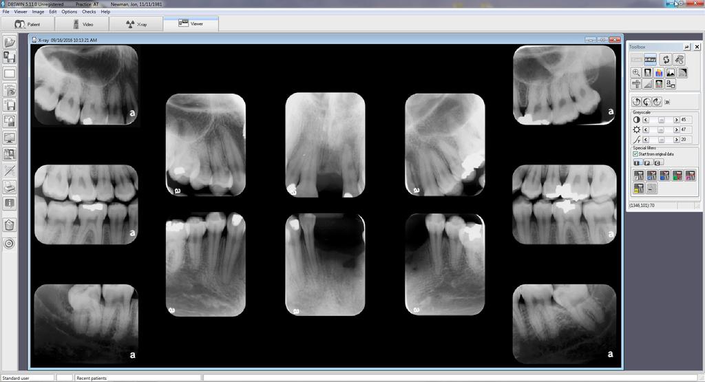 This means that caries can be depicted with a high level of reproducibility and used as a tool to increase patient communication.