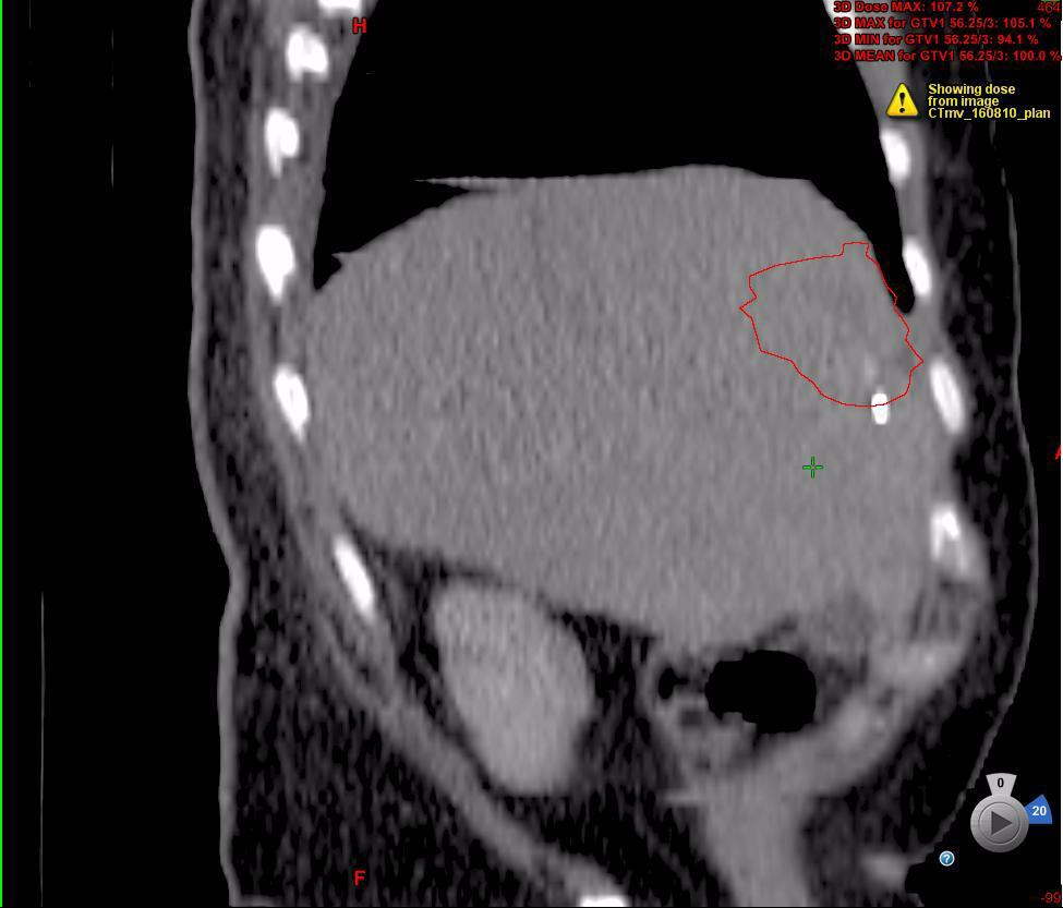 Liver SBRT planning and setup Marker implantation Fixation CT