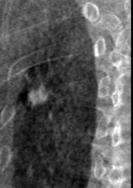 Results: Patient Study Results: Patient Study Radiographic 30 o 4D DTS Radiographic 30 o 4D DTS 200 o CBCT Maurer et al AAPM 2009. Scan data from Tinsu Pan (MD Anderson) 57 GRS = 0.