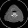 predicted tumor volume (delineated on planning CT) at EI shown on NST Maltz et al AAPM 2009 73