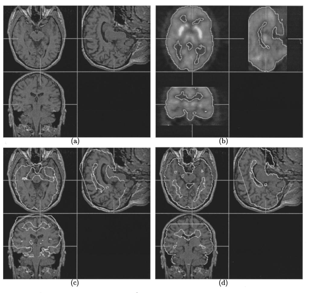 31 Studholme, Hill, and Hawkes: Automated 3D registration of MR and PET brain images 31 FIG. 2.