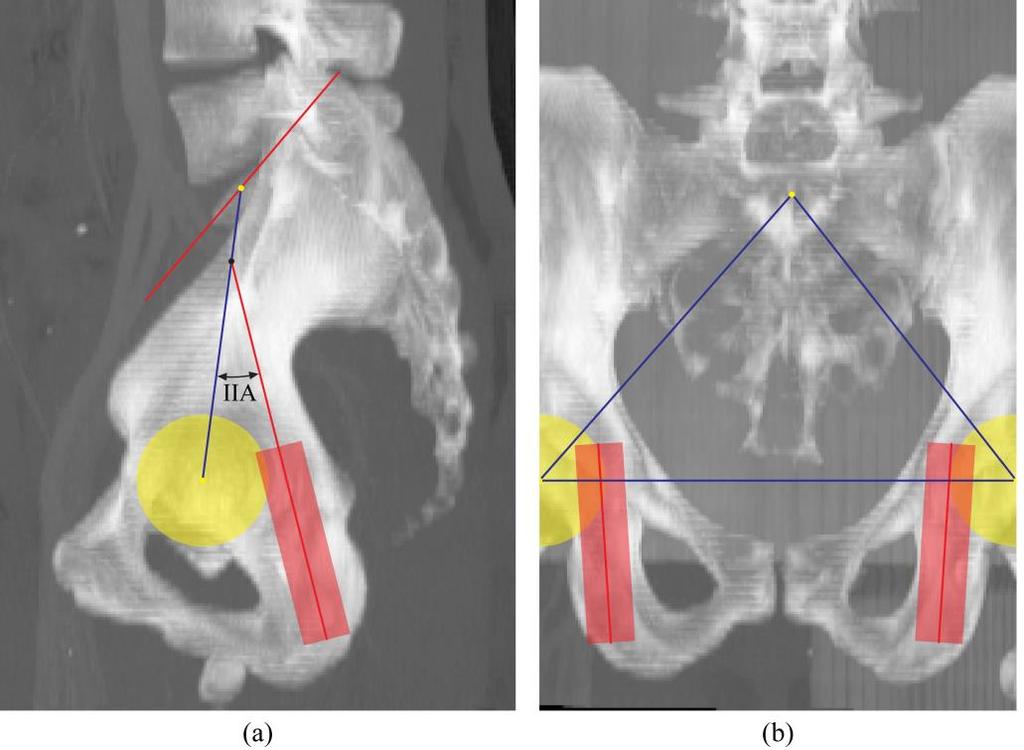 Computation of the ischio-iliac angle Before computing the ischio-iliac angle, multiplanar 3D image reformation was performed to obtain the superposition of the femoral heads in the sagittal view.