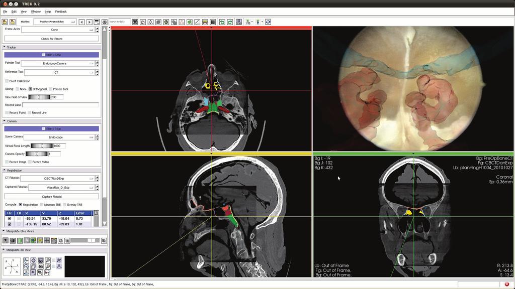 SPIE Medical Imaging 2011 Proc. Visualization, Image-Guided Procedures, and Display Table 1: Summary of TRE measurements in the cadaver study. TRE (mm) of the OCR (N=4) Volume 7964 registration.