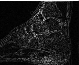 an magnetic-resonance image of foot.