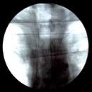 View into the released tracheal stent Test image of radiopacity in a water bath Covering