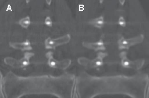 Computed tomography after lumbar spine metallic material arthrodesis Figure 7. Coronal, oblique reconstructions.