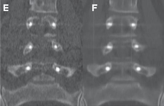 A low noise level is highly favorable to color 3D reconstructions with the VRT technique, resulting in high quality images of the lumbar spine.
