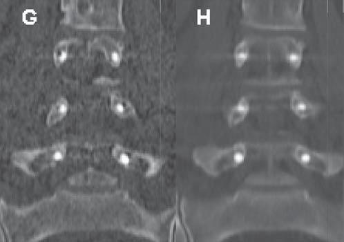 with intermediate filters like 0 and 0. These results are justified by the higher spatial resolution allowing a better visualization of grooves or alterations on pedicle screws.