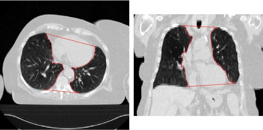 (Color version available online at http://ieeexplore.ieee.org.) Fig. 30. Contours of representing the region between the lungs, superimposed on an axial slice and on a coronal slice.