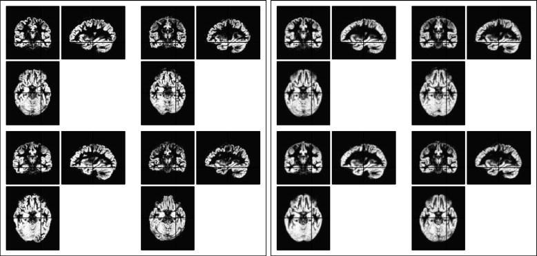 1.2.2 DARTEL DARTEL[23] is another common program applied on MRI brain images to perform inter-subject registration research or realignment of small inner structures.