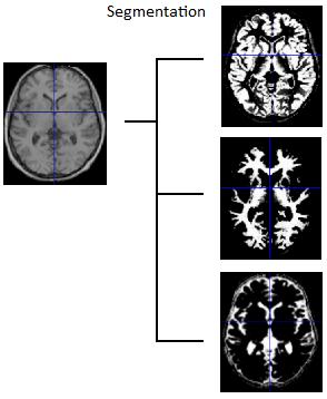 Figure 8. An example of segmentation of an original brain scan (left) partitioned it into GM, WM, and CSF (right; from top to bottom respectively). 1.2.