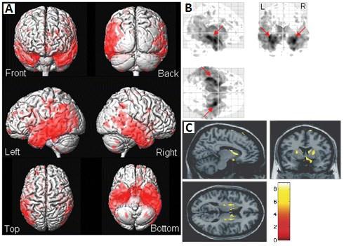 Figure 12. [50] Figure A shows six different views of a 3D render of the brain, with the voxels in red representing those with significantly reduced GM volume in subjects versus controls.