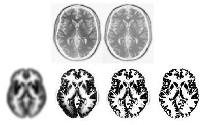 Figure 14. [42] The top row (from left to right) shows the original T1 weighted MR simulated BrainWeb[1] images: 100% nonuniformity and 100% nonuniformity corrected.