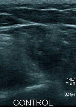 86 König et al. Fig. 5. Examples of misclassified images for healthy (left, SCE of 81.30%) and pathological (right, SCE of 62.88%) muscles. yse myositis from ultrasound images.