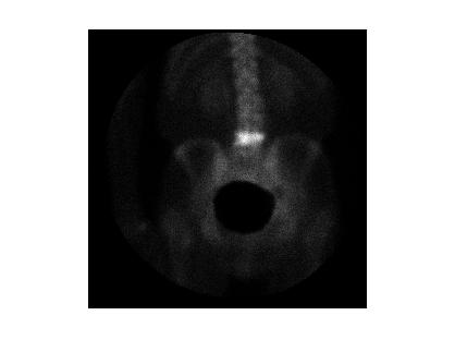 SPECT example: spine image