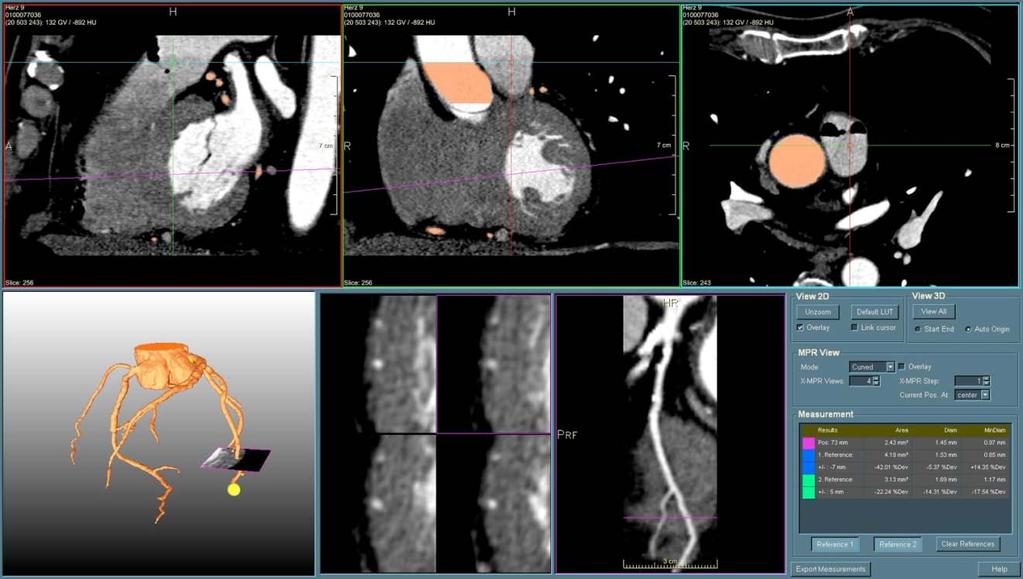 Characterization Direct visualization of contrast-enhanced 3D/4D data Requires neither a segmentation nor an analysis of vasculature Often prefiltering of the data to further enhance vessels