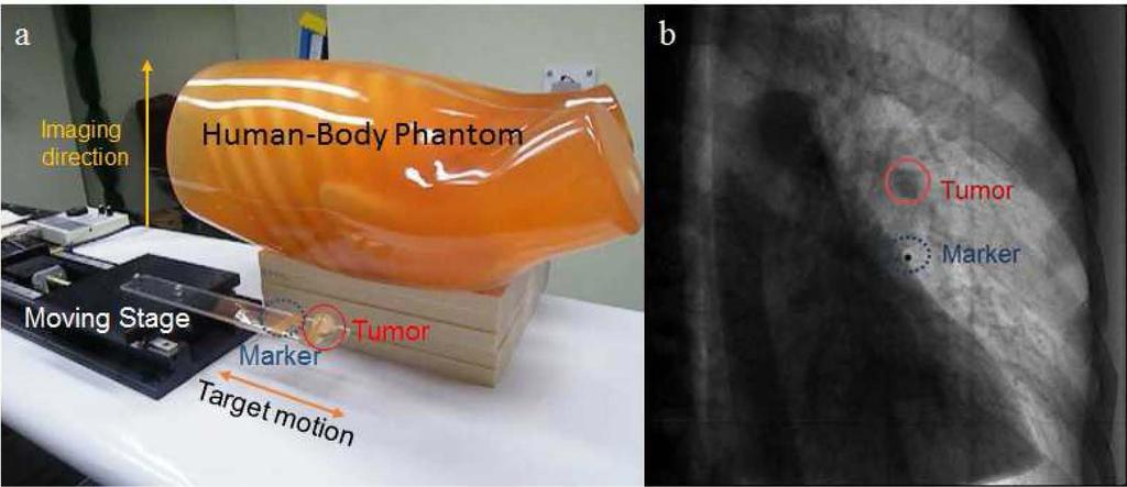 Figure 2. (a) The human-body and linearly driven motion stage phantom; (b) Input fluoroscopic image obtained from the phantom.