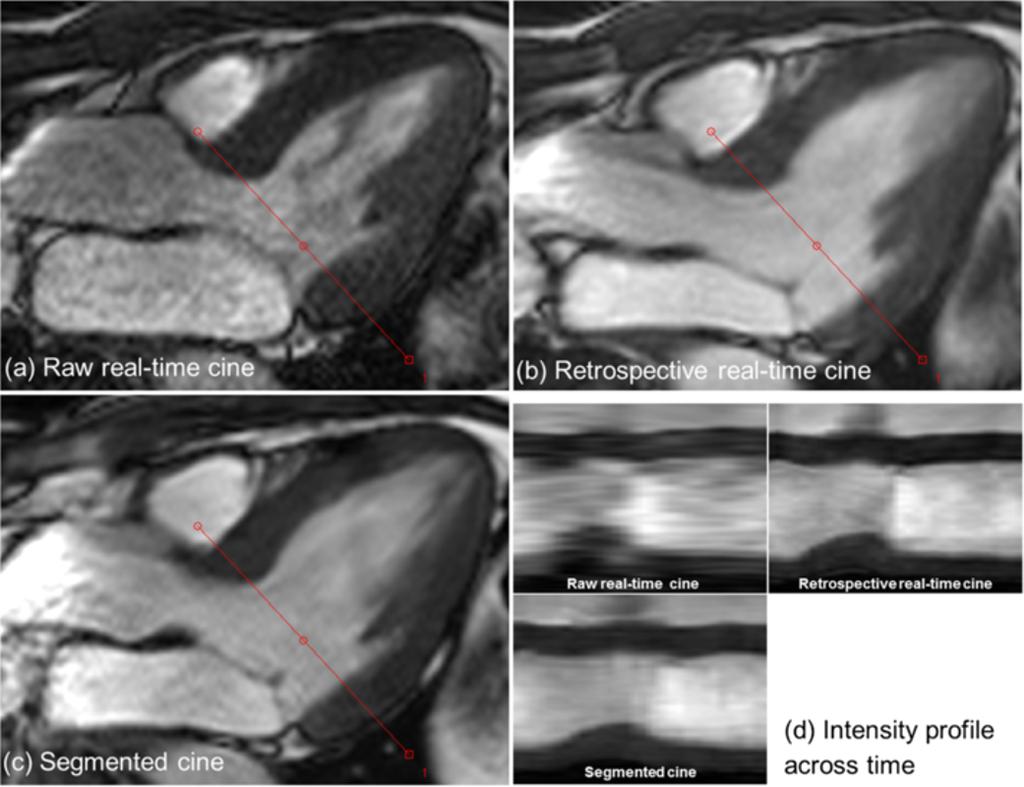 Xue et al. Journal of Cardiovascular Magnetic Resonance 2013, 15:102 Page 10 of 15 Figure 6 Retrospective real-time cine with improved temporal resolution can enhance the visualization of valve.