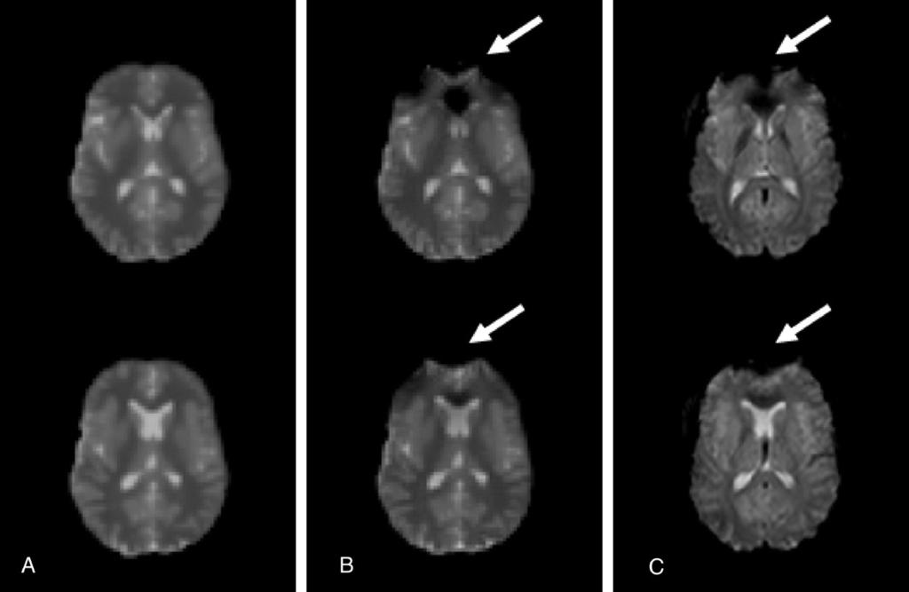 N. Xu et al. / Magnetic Resonance Imaging 25 (2007) 1376 1384 1381 Fig. 5. Comparison of simulated GE-EPI image with real GE-EPI of human head.
