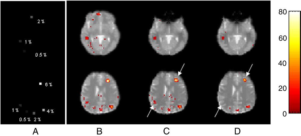 N. Xu et al. / Magnetic Resonance Imaging 25 (2007) 1376 1384 1383 Fig. 8. The functional analysis from SPM2 (two slices are shown from top to bottom).