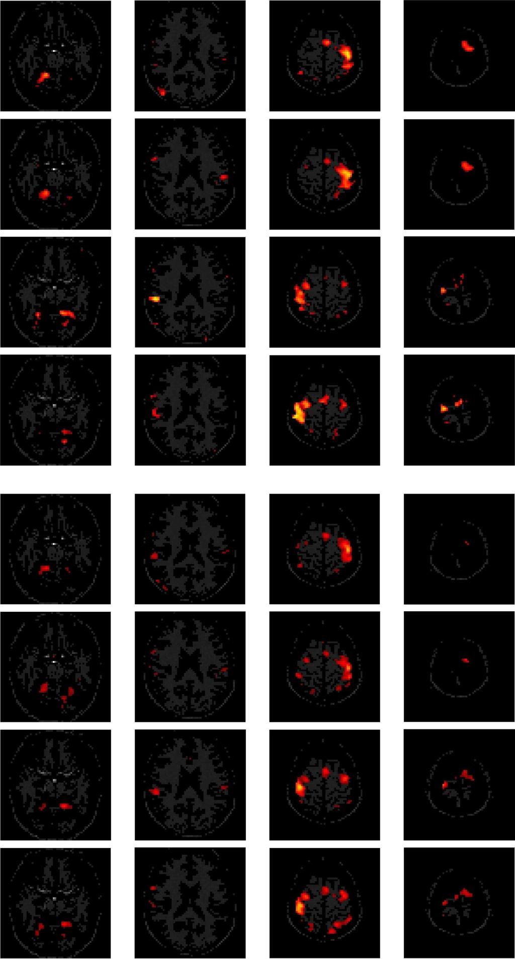 Figure 6 Brain regions activated by the four finger movements detected by two methods Panel (I): Adaptive SPM, EG right-hand (first row), IG right-hand (second row), EG left-hand (third row) and IG