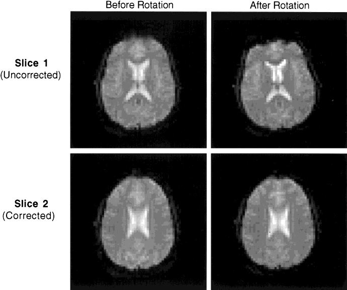 Prospective Multiaxial Motion Correction for fmri 465 FIG. 4. Correction of motion: in vivo anatomic images.