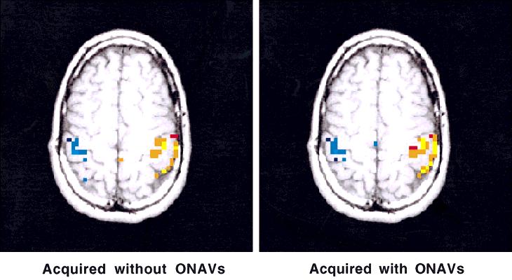 466 Ward et al. FIG. 5. Effect of ONAVs on sensitivity to the BOLD phenomenon.