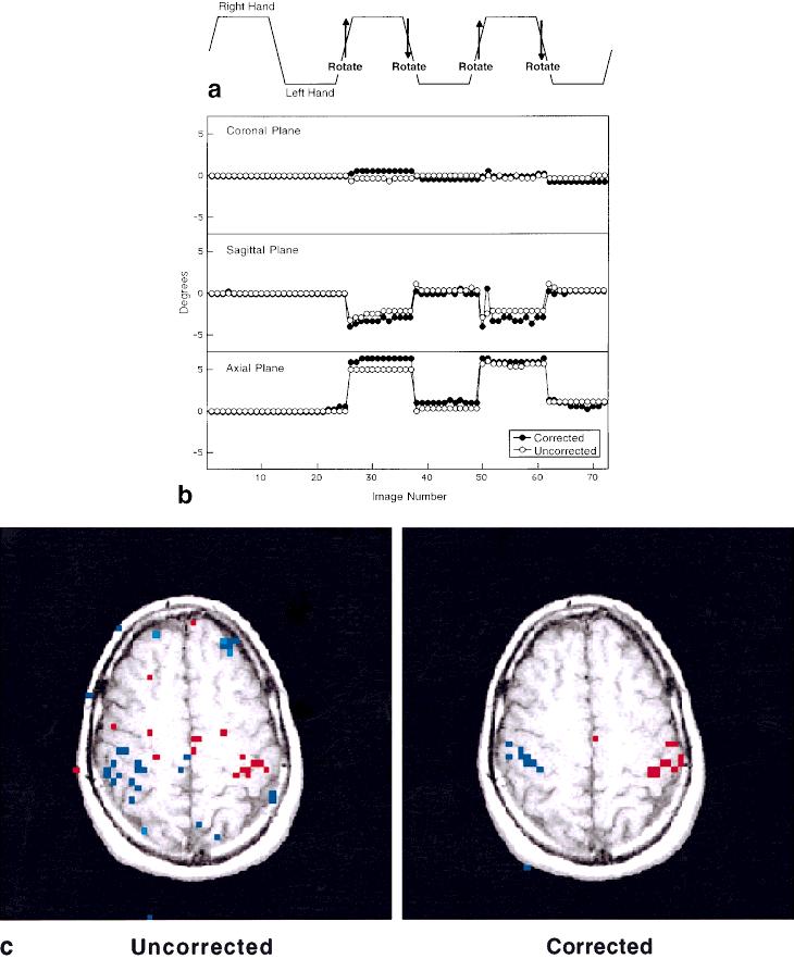 Prospective Multiaxial Motion Correction for fmri 467 FIG. 6. Motion-corrected fmri. Head rotation was incorporated into an alternating hand, sponge-squeezing activation paradigm (a).