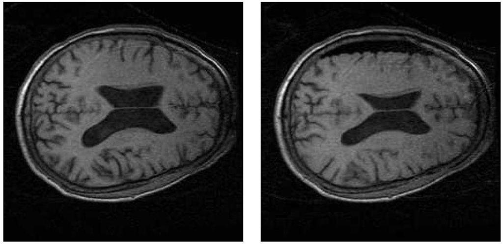 4000 3500 preprocessing parallel BM solver 3000 2500 Time (sec) 2000 1500 Figure 1: Same MRI volume slice before (left) and after (right) tumor resection.