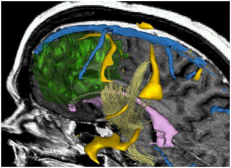 Figure 3: Left: MRI slice overlayed with fmri activation regions, DT-MRI tractography, and segmentations of tumor and other intra-cranial areas; right: 0.