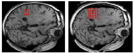 Intra-cranial cavity has to be segmented [Archip et al. 2006] from the high resolution MRI of the patient before the surgery.