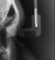 the proximal femur in pelvic radiographs.