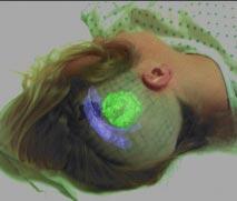 Figure 1-3: Augmented Reality Visualization where internal structures are overlaid on a video image of the patient. LEFT: The ventricles appear in blue and the tumor appears in green.