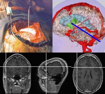 Figure 1-4: As the surgeon moves the trackable probe around the patient's head (upper left), an arrow shows the corresponding position in the rendered image of 3D models (upper right) and the